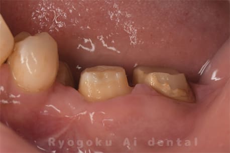 慢性根尖性歯周炎並びに重度歯周病の併発