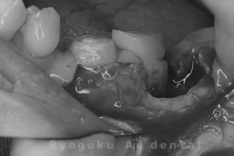 マイクロエンド並びに歯周再生療法手術