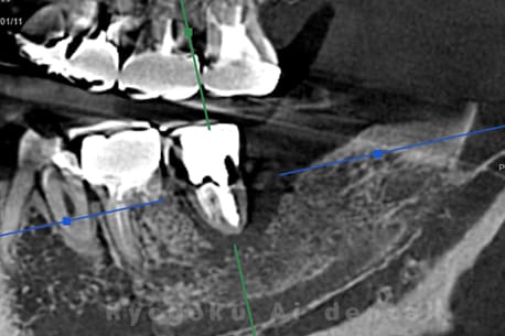 マイクロエンド並びに歯周再生療法手術前CT画像