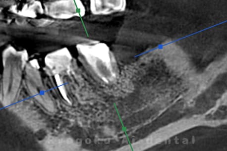 マイクロエンド並びに歯周再生療法手術後CT画像
