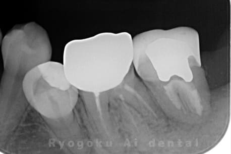 マイクロエンド並びに歯周再生療法手術前レントゲン写真