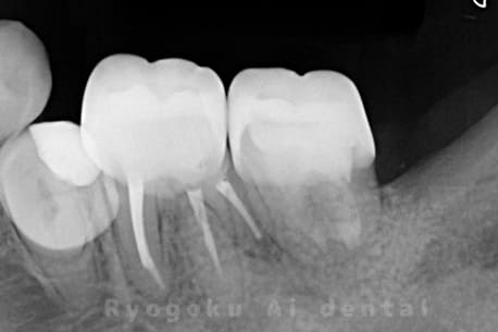 マイクロエンド並びに歯周再生療法手術後レントゲン写真