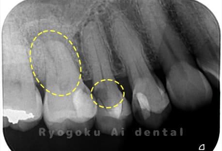 右上６番慢性根尖性歯周炎、右上５番重度カリエス
