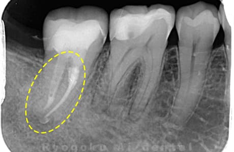 マイクロエンド治療、セラミッククラウン修復レントゲン写真術後