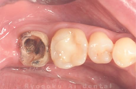重度カリエス、不良補綴物、慢性根尖性歯周炎術前