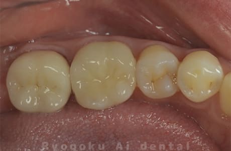マイクロエンド治療、セラミッククラウン修復術後
