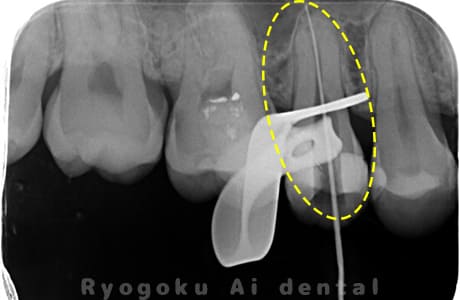 マイクロエンド術中