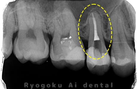 マイクロエンド術後