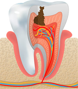 虫歯の状態