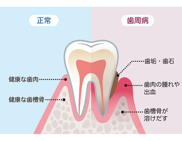 歯周病は静かに進行していく病気