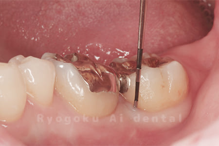 重度慢性歯周病の再生療法