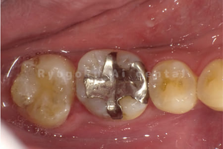 自家歯牙移植手術＋マイクロエンド＋ダイレクトボンディング