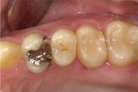 自家歯牙移植手術＋マイクロエンド＋ダイレクトボンディング
