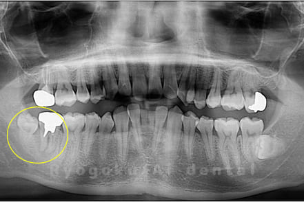 重度カリエス、慢性根尖性歯周炎術前重度カリエス、慢性根尖性歯周炎レントゲン