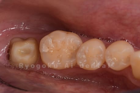 慢性根尖性歯周炎
