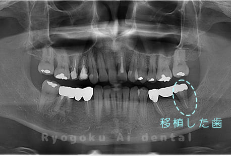 自家歯牙移植後のレントゲン