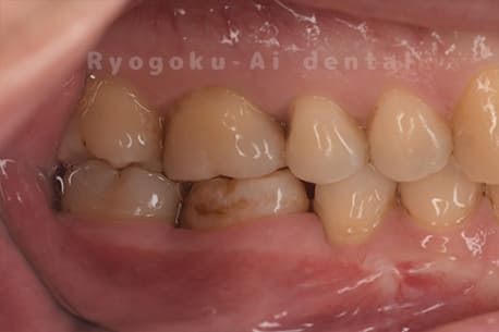 右下8を右下6へ移植に自家歯牙移植後のレントゲン