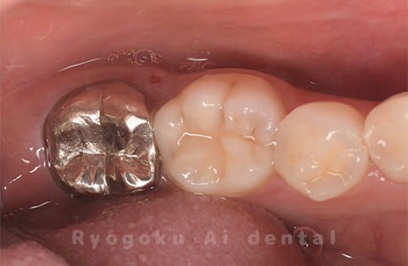 右下７番慢性根尖性歯周炎、右下８番智歯周囲炎