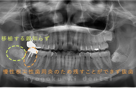 右下７番慢性根尖性歯周炎、右下８番智歯周囲炎