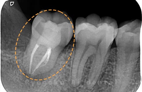 自家歯牙移植後のレントゲン