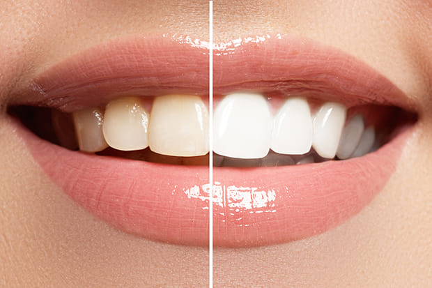 ホワイトニングで白く綺麗な歯を手に入れよう！