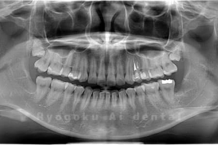 下顎の水平埋伏智歯を抜歯