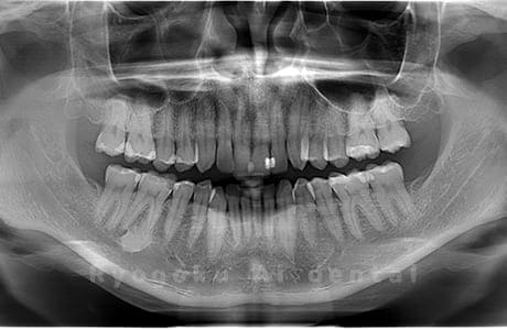 上顎左右の親知らずを抜歯
