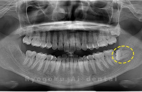 下顎左の親知らず
