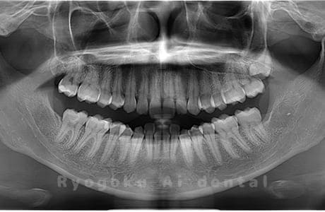 下顎左の親知らずを抜歯