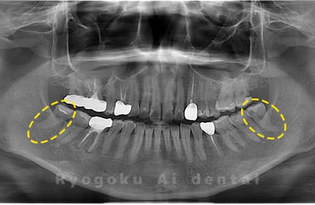 下顎左右の親知らず