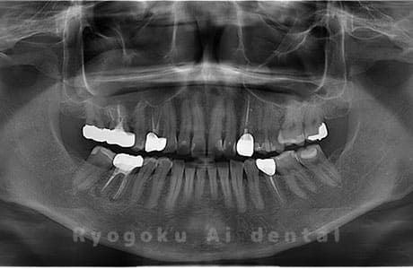 下顎左右の親知らずを抜歯