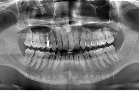 下顎左右の親知らずを抜歯