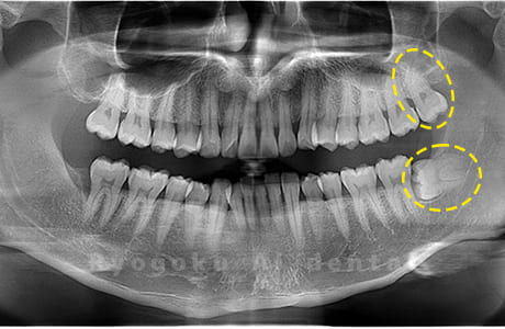 上顎左・下顎左の親知らず