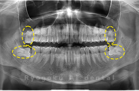 上顎左右・下顎左右の親知らず