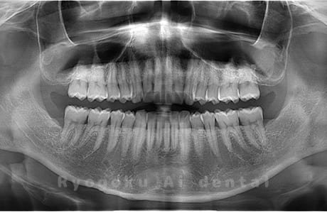 上顎左右・下顎左右の親知らずを抜歯
