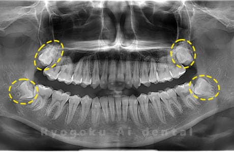 上顎左右・下顎左右の親知らず