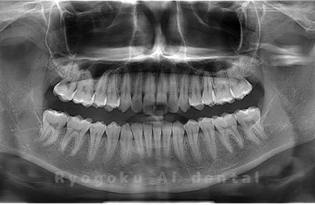 上顎左右・下顎左右の親知らずを抜歯