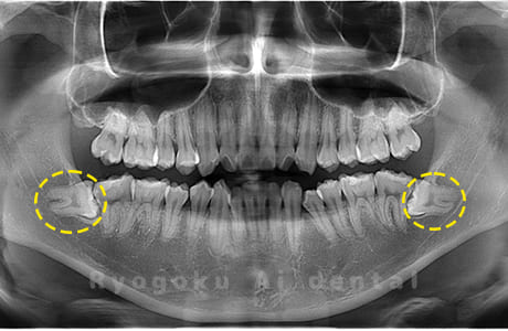 下顎左右の親知らず