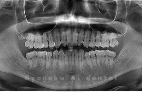 下顎左右の親知らずを抜歯