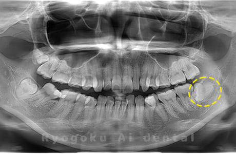下顎左の親知らず