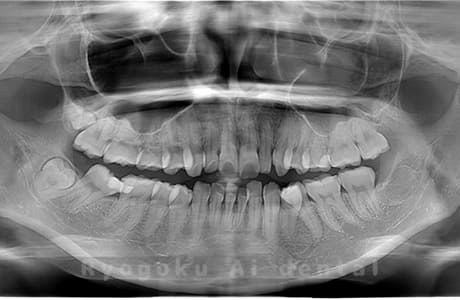 下顎左の親知らずを抜歯