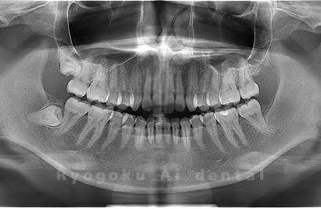 上下顎左の親知らずを抜歯