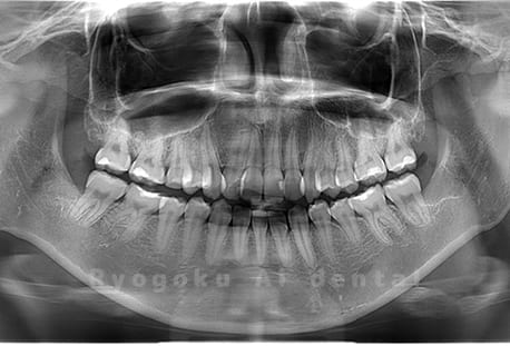 下顎左右の埋伏の親知らずの抜歯