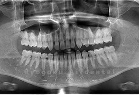 上下顎左右の4本の親知らずの抜歯
