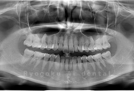 上下顎左右の4本の親知らずの抜歯
