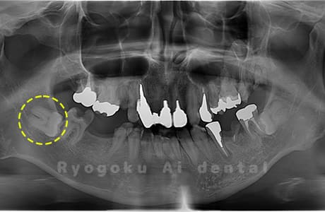 下顎右の親知らず