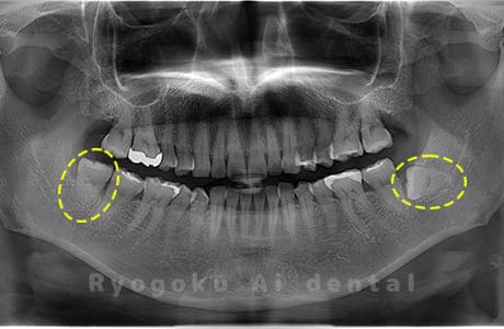 下顎左右の親知らず