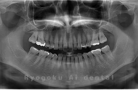 下顎左右の親知らずの親知らずを抜歯