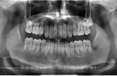 下顎左右の親知らずの親知らずを抜歯