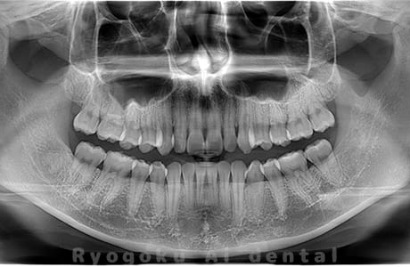 下顎左の親知らずの親知らずを抜歯